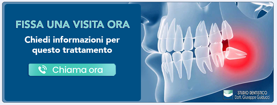trattamento-dei-denti-del-giudizio Pescara